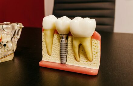De ce este necesar sa inlocuiesti lipsa dintelui cu un implant dentar?